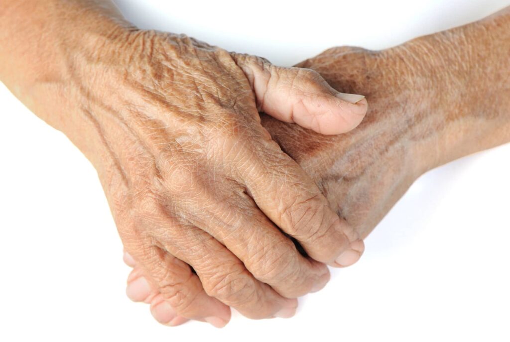 Veines dilatées les causes et les traitements Dr Cormary Lyon