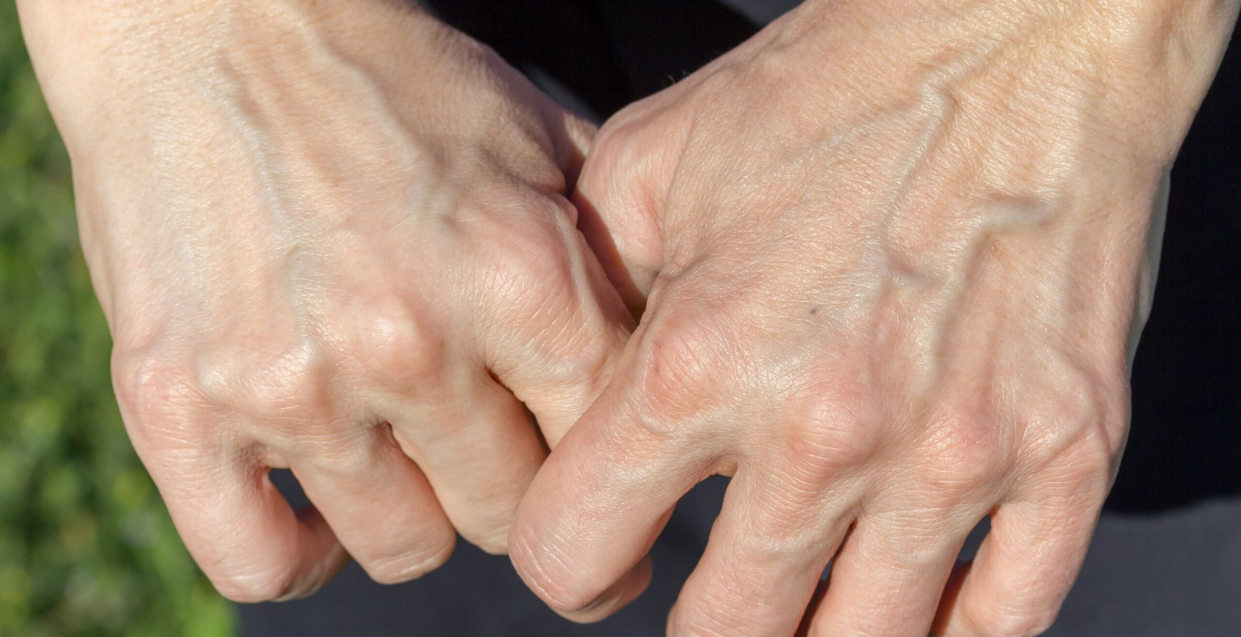 Sclérothérapie partielle et comblement d’Acide Hyaluronique pour les mains|Dr Cormary | Lyon